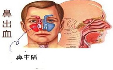 正确治疗鼻出血,有什么方法快速治疗鼻出血