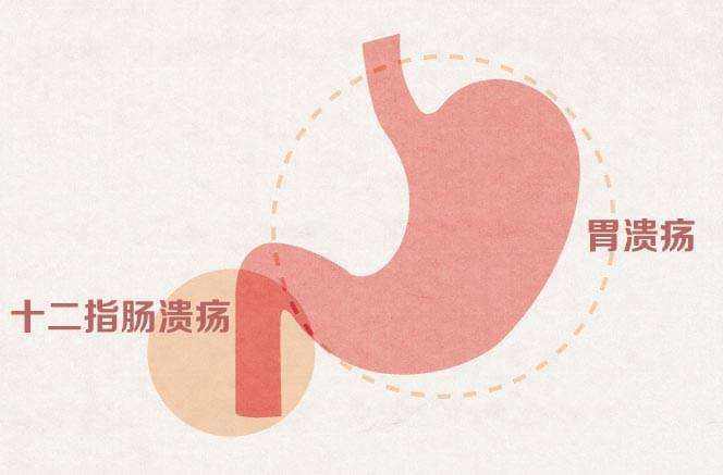 肠道上长溃疡是怎么回事,肠道上有溃疡能自愈吗