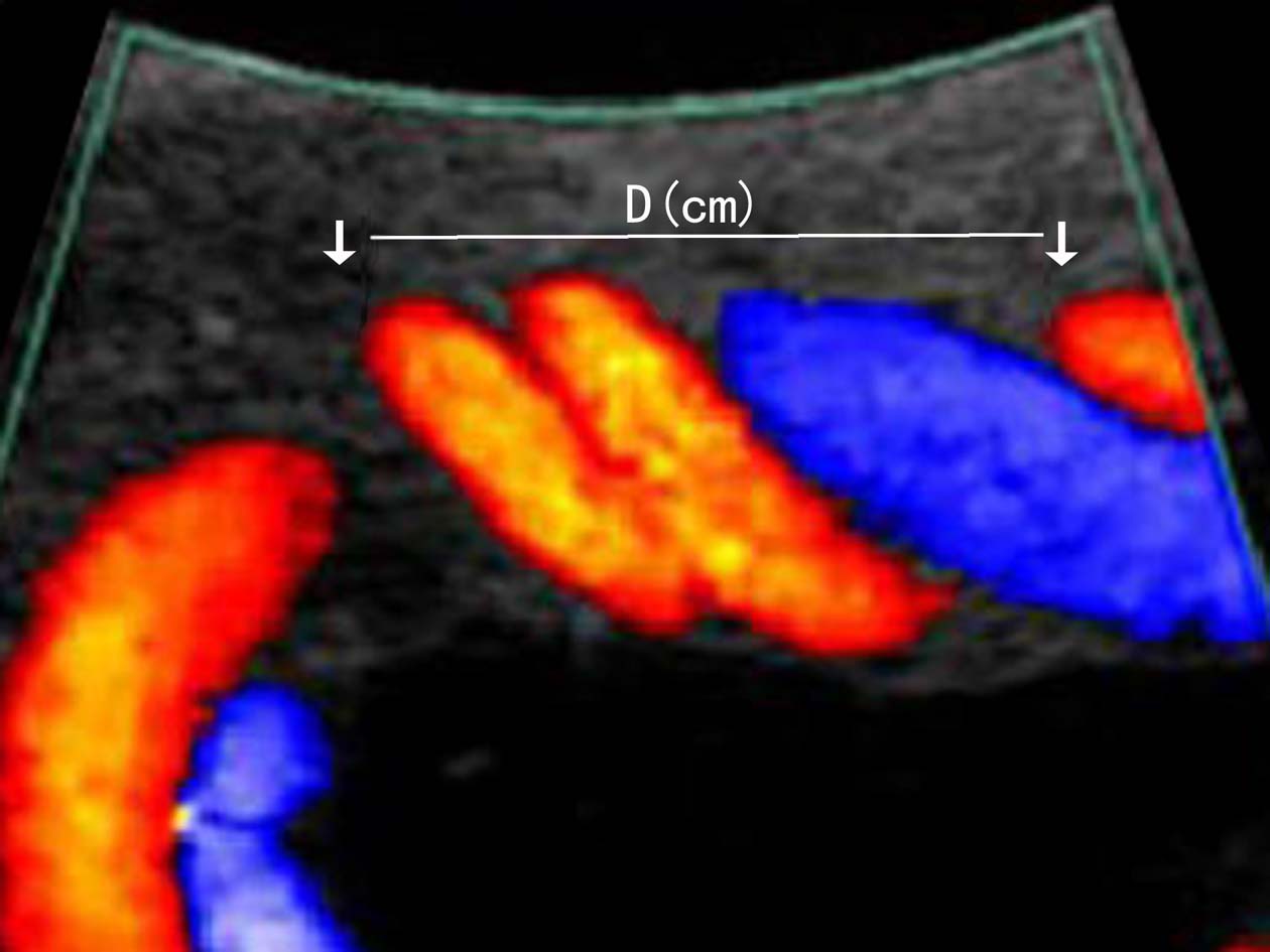 做高清彩超能看出脐带扭转吗,脐带超声异常