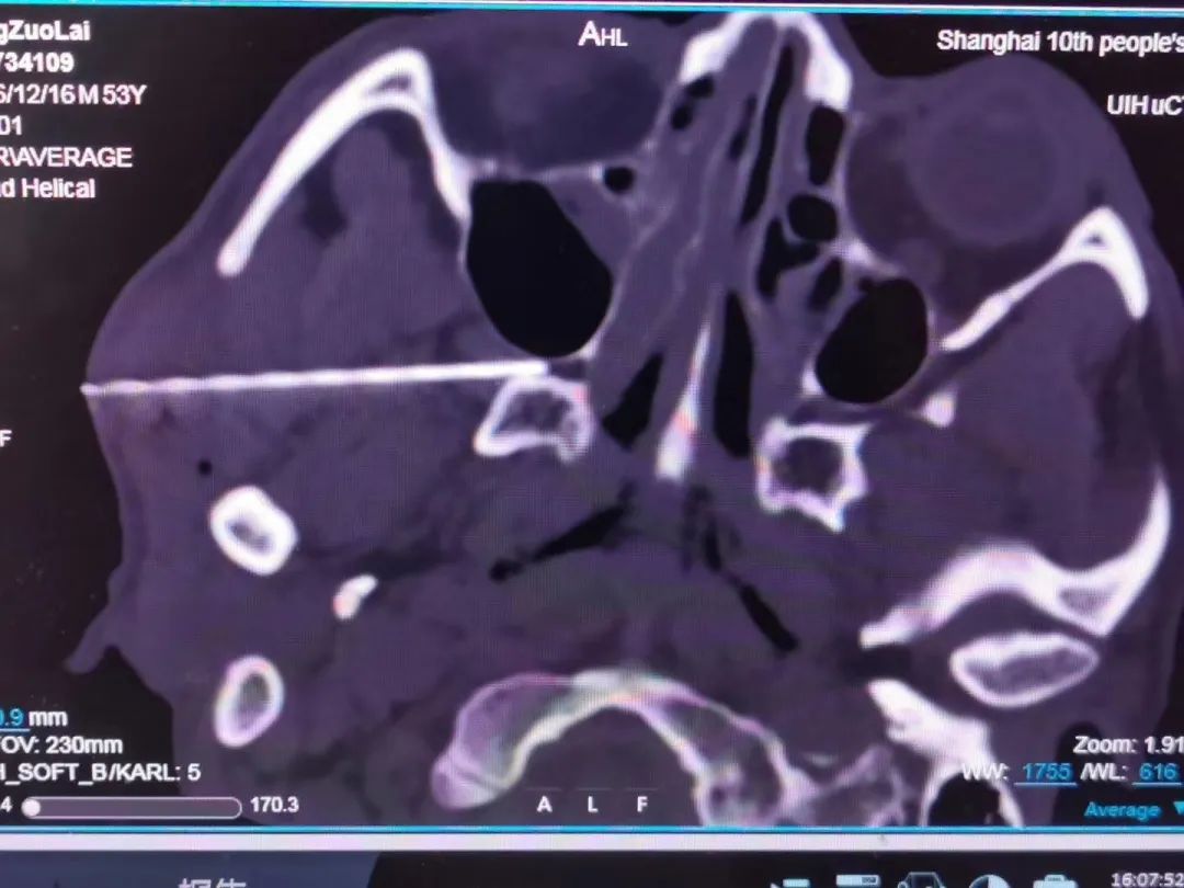 疼痛科治疗头痛的方法,疼痛科怎么治疗头疼