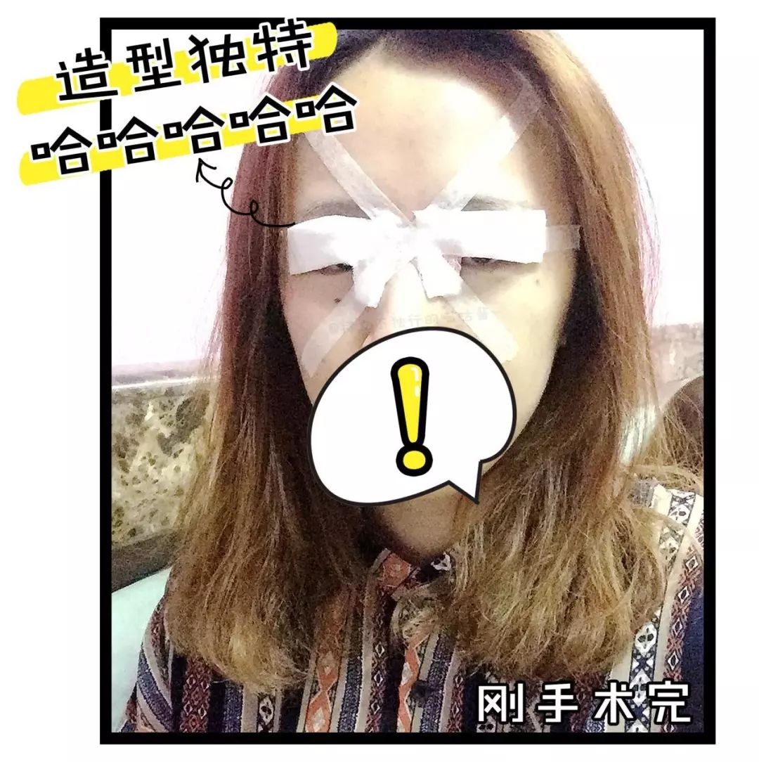 割双眼皮术前术后对比图,割双眼皮术前需要注意事项