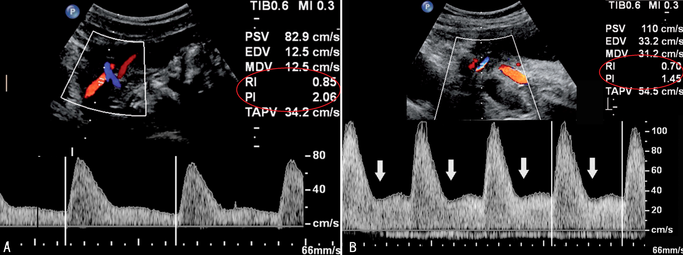 胎儿多普勒超声监测,胎儿多普勒超声检查对照表
