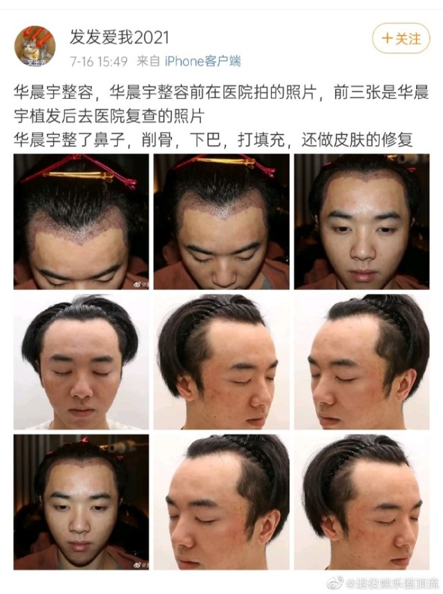 为什么华晨宇植发效果好,华晨宇植发图片是真的吗