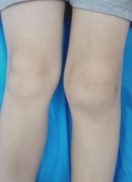 6岁小孩膝盖关节肿疼是怎么回事,儿童膝盖风湿有哪些症状