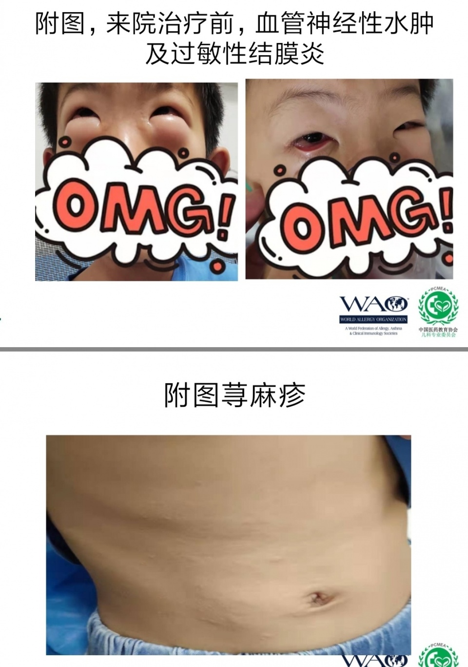 甲醛中毒引起的皮肤过敏怎么办,甲醛引起皮肤过敏用什么治疗