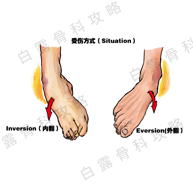 疫情期间崴到脚,在家里面可以这样进行紧急处理