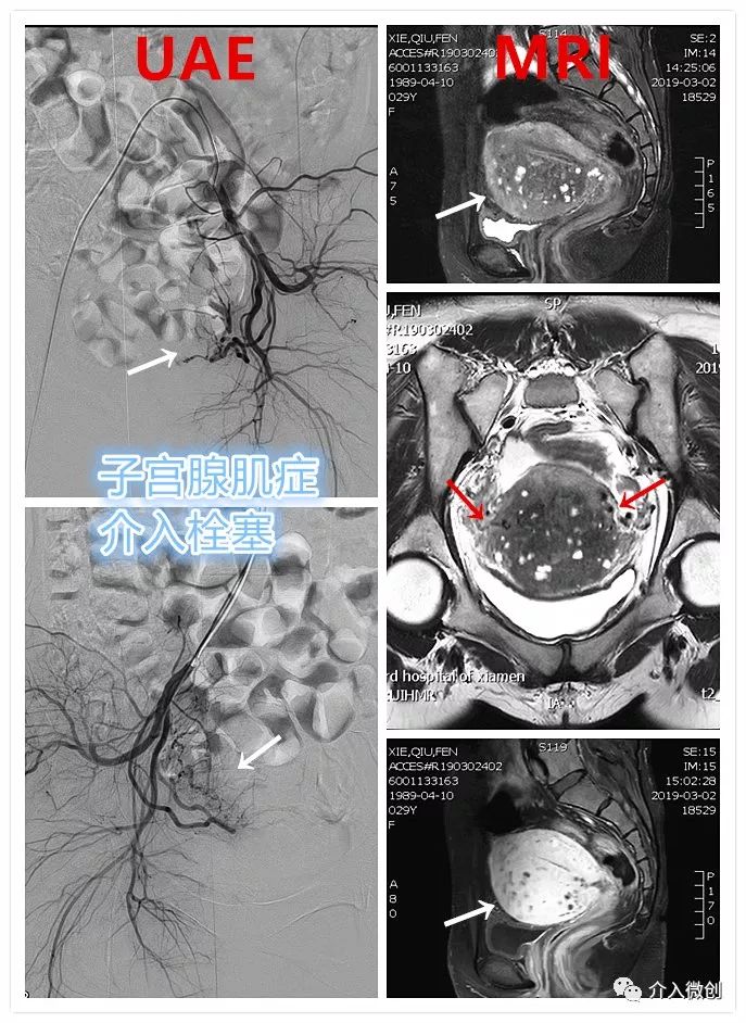 子宫腺肌病微创介入治疗时机