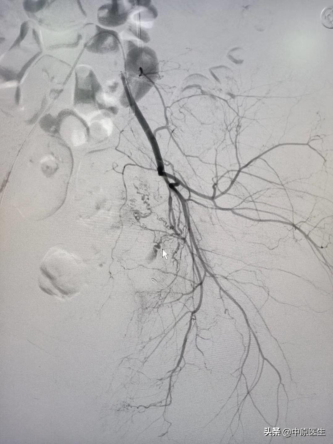 宫颈鳞癌需要切除哪里,宫颈鳞癌出血怎么处理