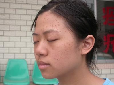 颈部上的小肉球如何处理,颈部突然长了个小疙瘩是怎么回事