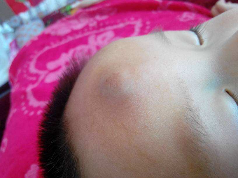 小磕小碰、摔伤烧伤在所难免,不想去医院,在家如何安全处理?