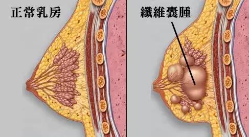 一分钟教你看懂乳腺报告单,乳腺检查报告4b怎么办
