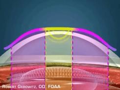 古代人近视怎么办动画,古代人近视了怎么治疗的