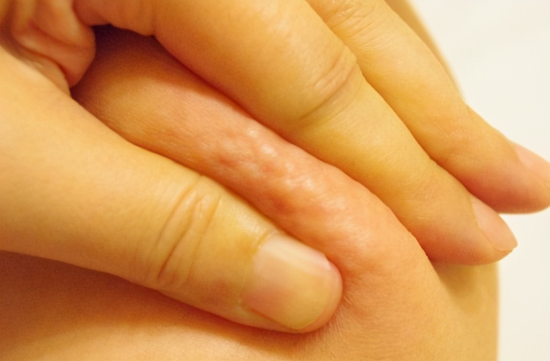 橘皮组织的最佳治疗方法,橘皮症与橘皮纹