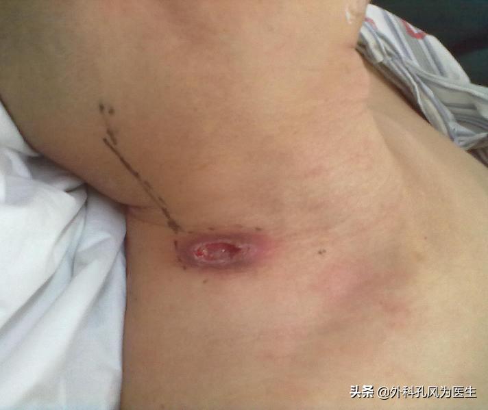 脖子老鼠疮,脖子上长老鼠疮图案