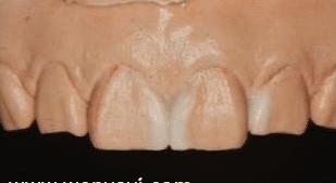 门牙缝可以补吗,门牙有缝怎么办如何补救