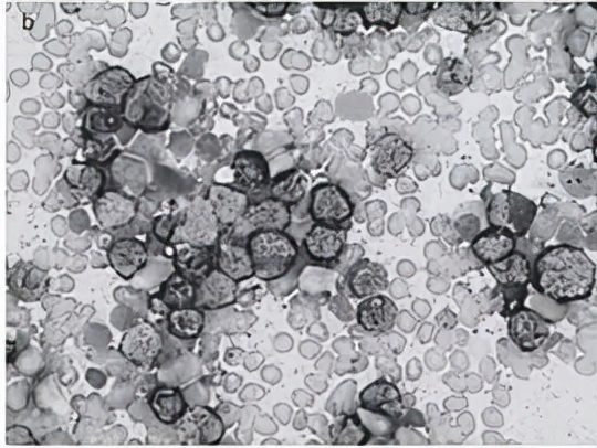 干细胞可以治疗代谢疾病吗,代谢性疾病中国有办法根治吗
