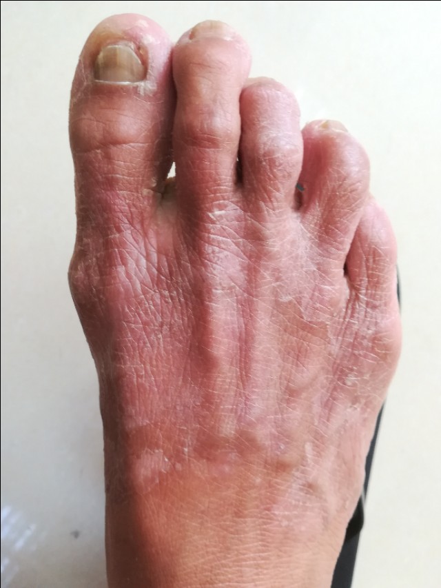 干燥敏感皮肤夏天怎么护理,夏天脸部皮肤脱皮干燥怎么办