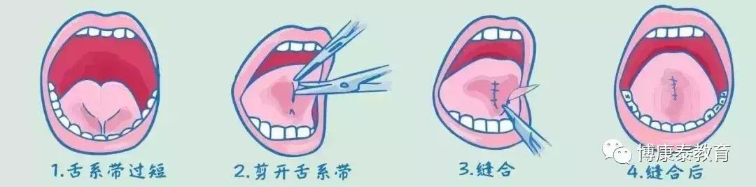 博康泰丨剪舌筋：该不该让孩子挨这一刀？