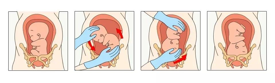 宝宝看臀位判断髋关节,脐带绕颈2圈胎位臀位怎么纠正