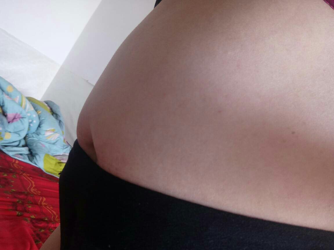 女人剖腹产两次就会有两道疤痕吗,女人剖腹产三次后果会怎样