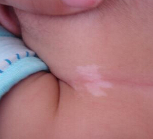 小孩身上有一块白斑怎么回事,身上有一块白斑汗毛也是白的