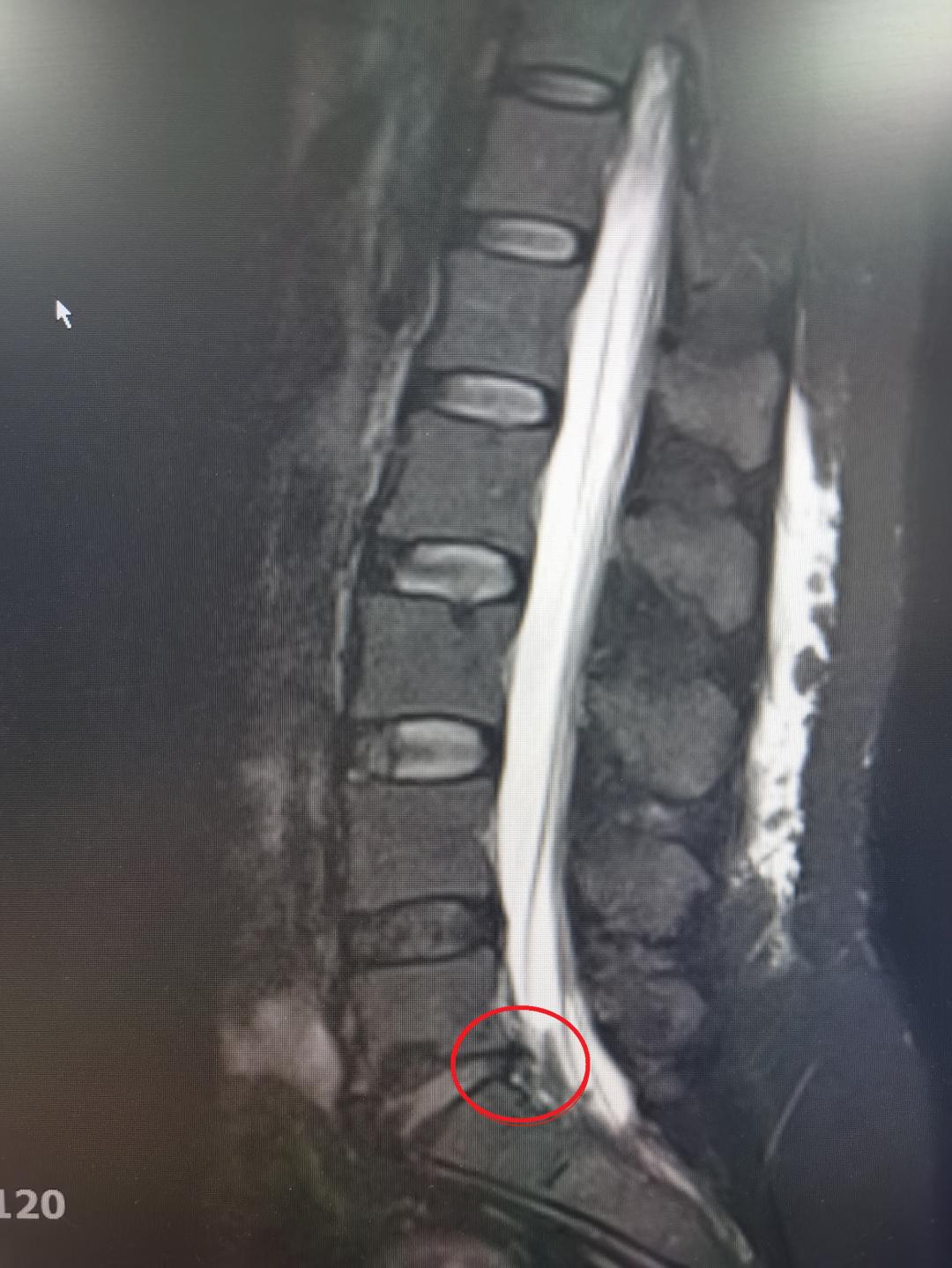宝妈腰间盘突出是什么引起的,宝妈生过宝宝后腰疼怎么办