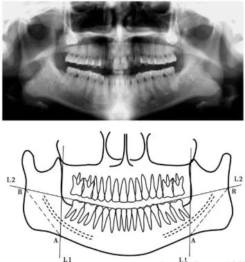 下颌角改善需要注意哪些方面,下颌角术后注意事项