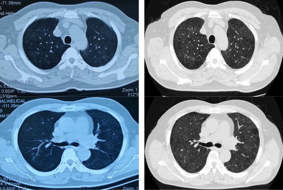 养鸽子造成皮肤真菌感染,养鸽子会得肺炎吗