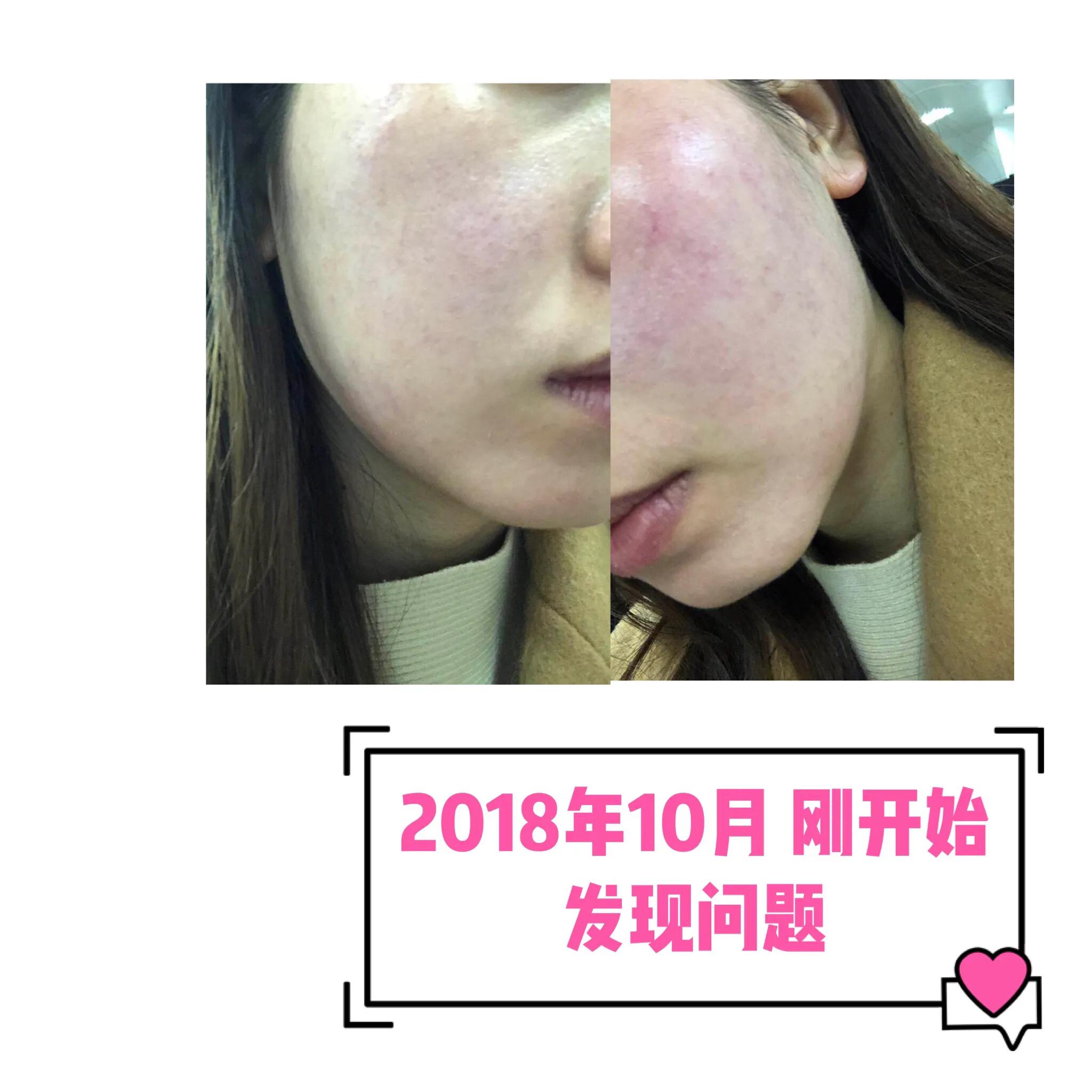 与病魔对抗的第30天,激素脸排毒第31天