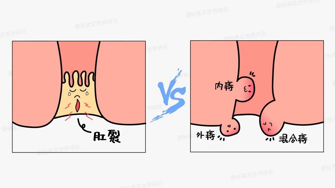 肛门疼痛、瘙痒、出血，到底是痔疮还是肛裂？