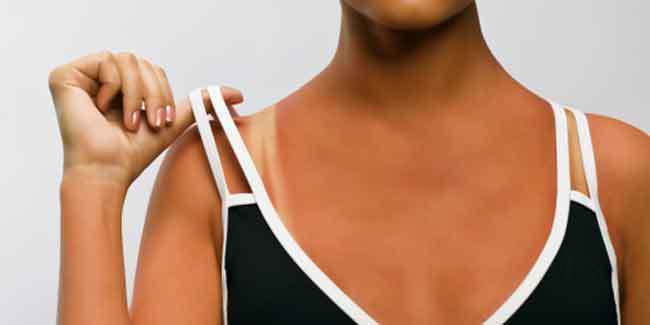 晒后皮肤疼如何快速修复,晒伤后出的晒痕如何处理