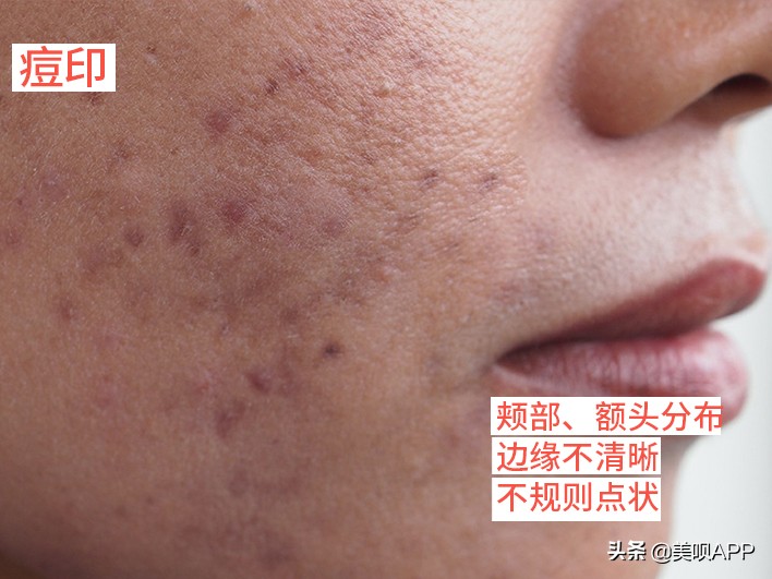 脸上有斑怎么祛斑最快最有效,脸上长斑点用什么药才能祛斑