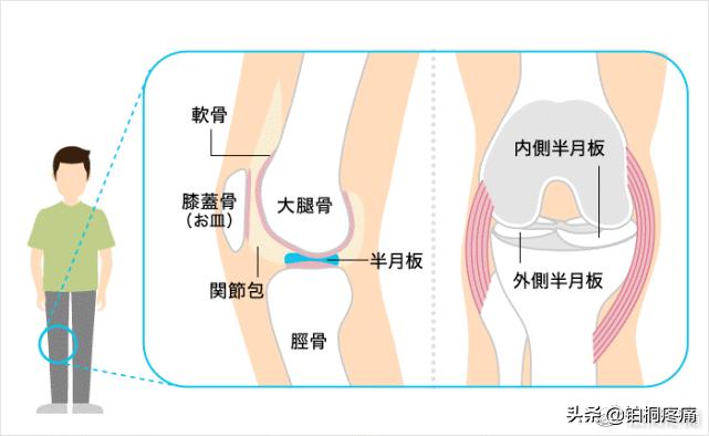 半月板虽然三度损伤但不影响走路,半月板损伤好了膝盖还是有点不直