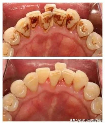 比较严重的牙周炎,时不时会流牙血应该如何治疗？