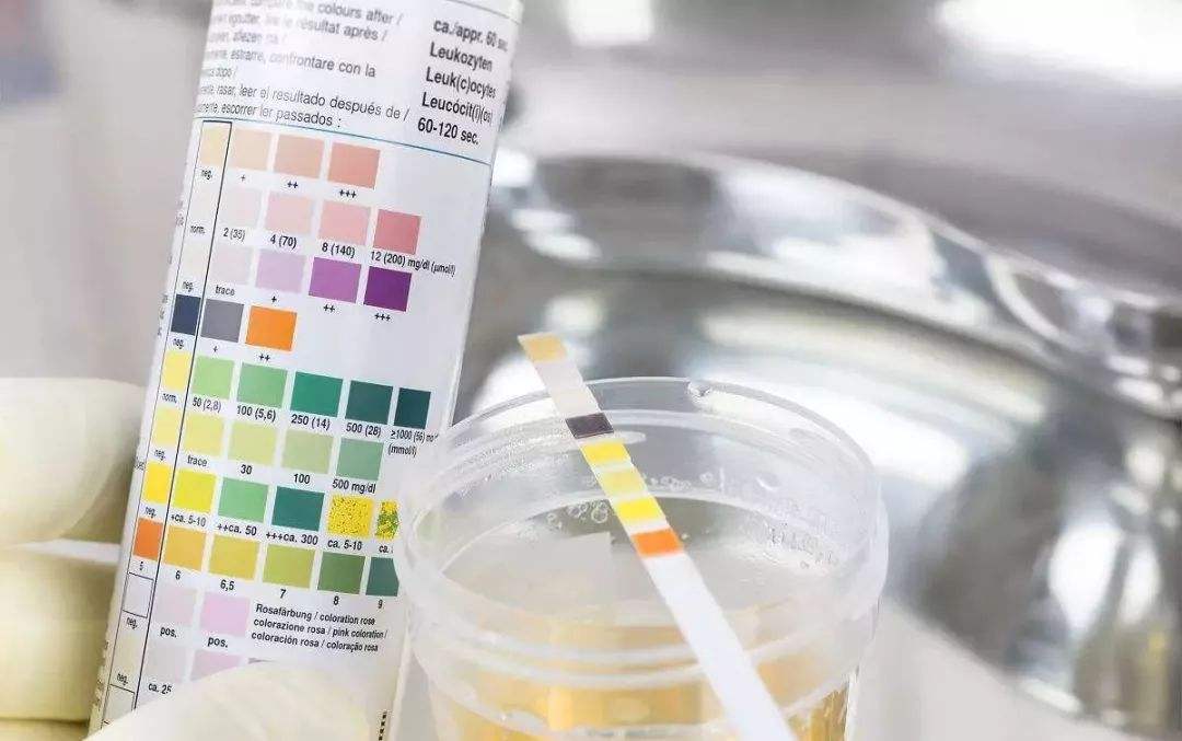 尿糖一般几个加号是糖尿病,尿糖跟糖尿病有什么区别