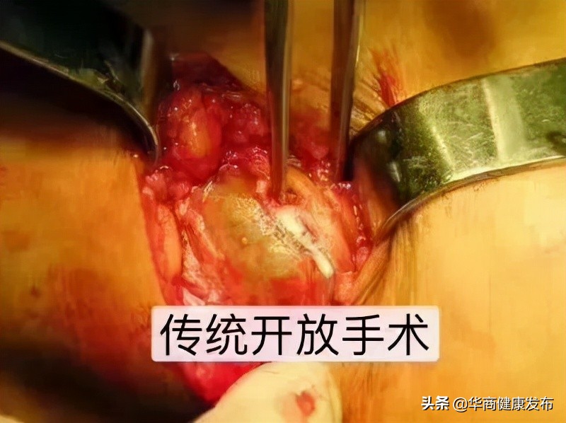 脚膝盖腘窝囊肿手术要注意什么,腘窝囊肿关节镜切除