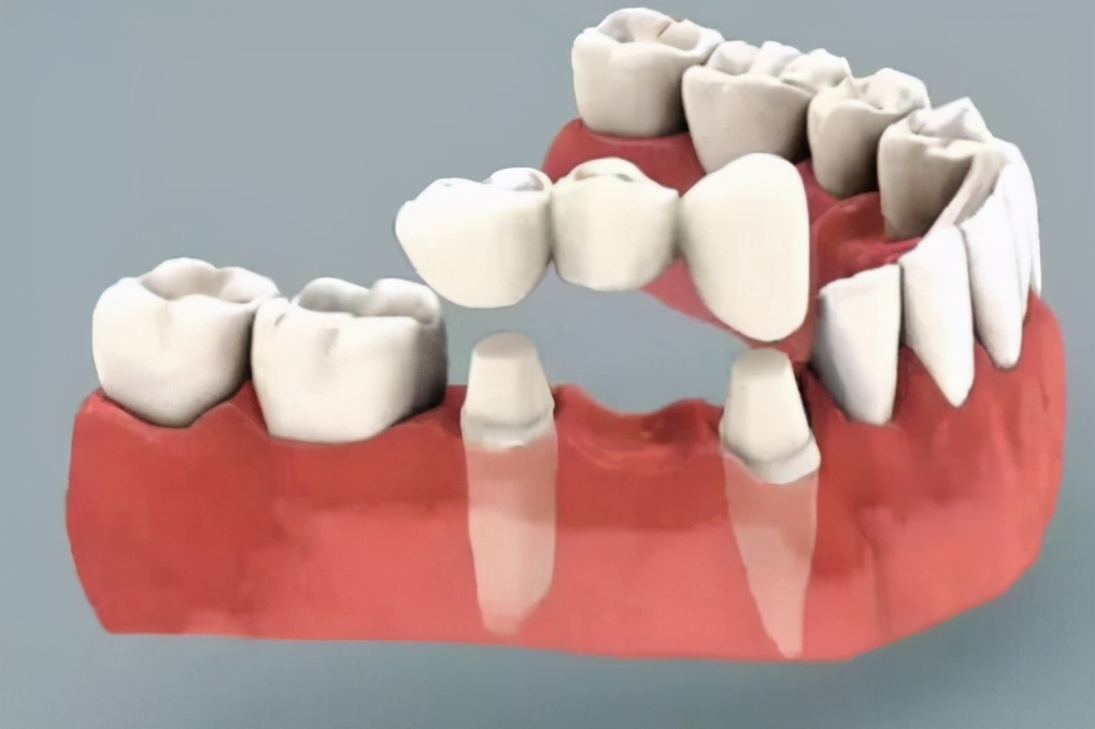明星的牙齿都是种植牙,明星的牙齿是全种植牙吗