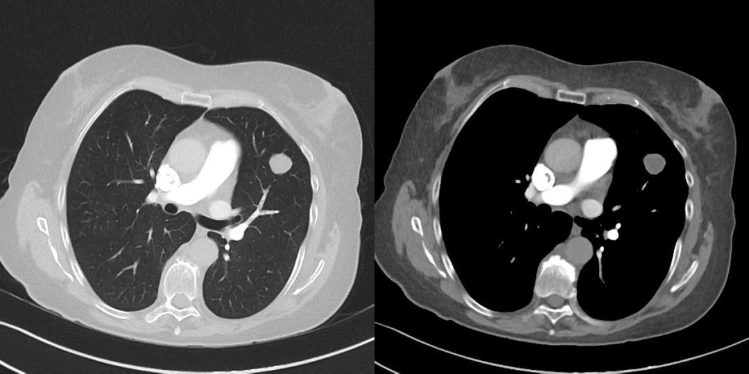 肺内见多发小囊状无纹理透光影,肺内肿块并厚壁空洞