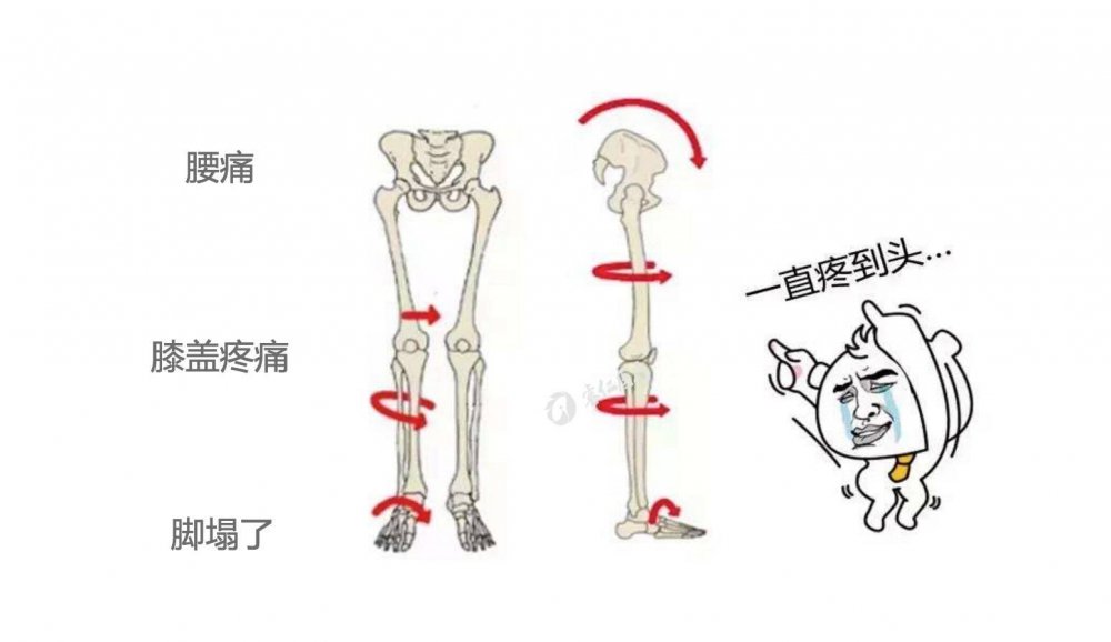 扁平足穿没有足底支撑的鞋,如何改善扁平足穿鞋的效果
