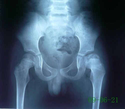 儿童股骨头坏死是怎么引起的,长期吃激素药怎样预防股骨头坏死