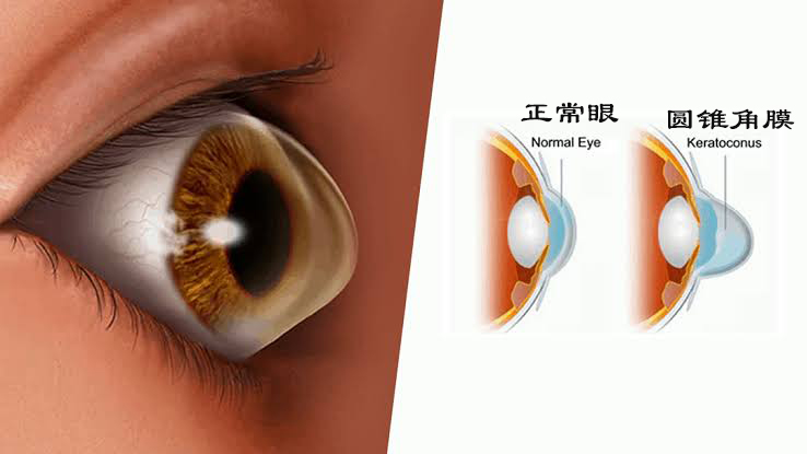 激光治疗近视什么原理,激光矫正是什么原理