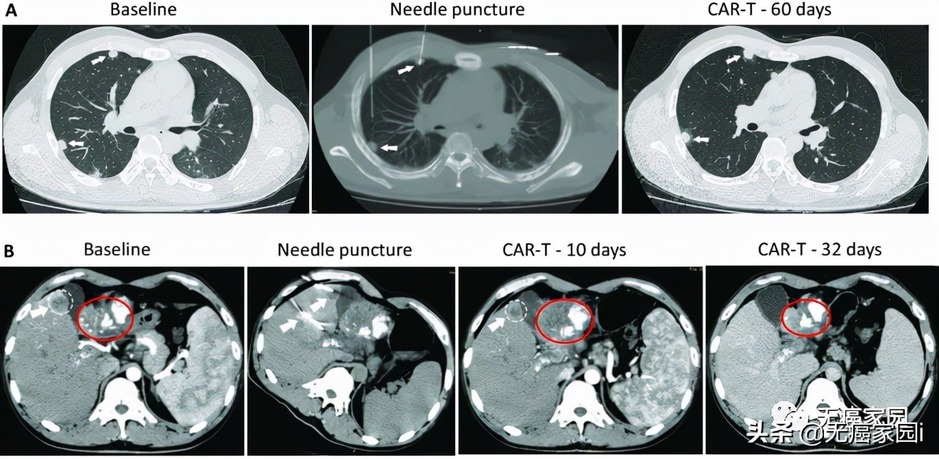 胰腺癌研究获重大突破,肝癌领域研究取得重大突破