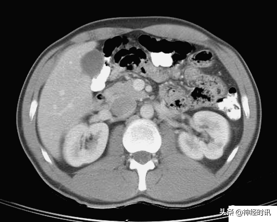 肾脏输尿管膀胱前列腺结构,肾输尿管膀胱解剖示意图