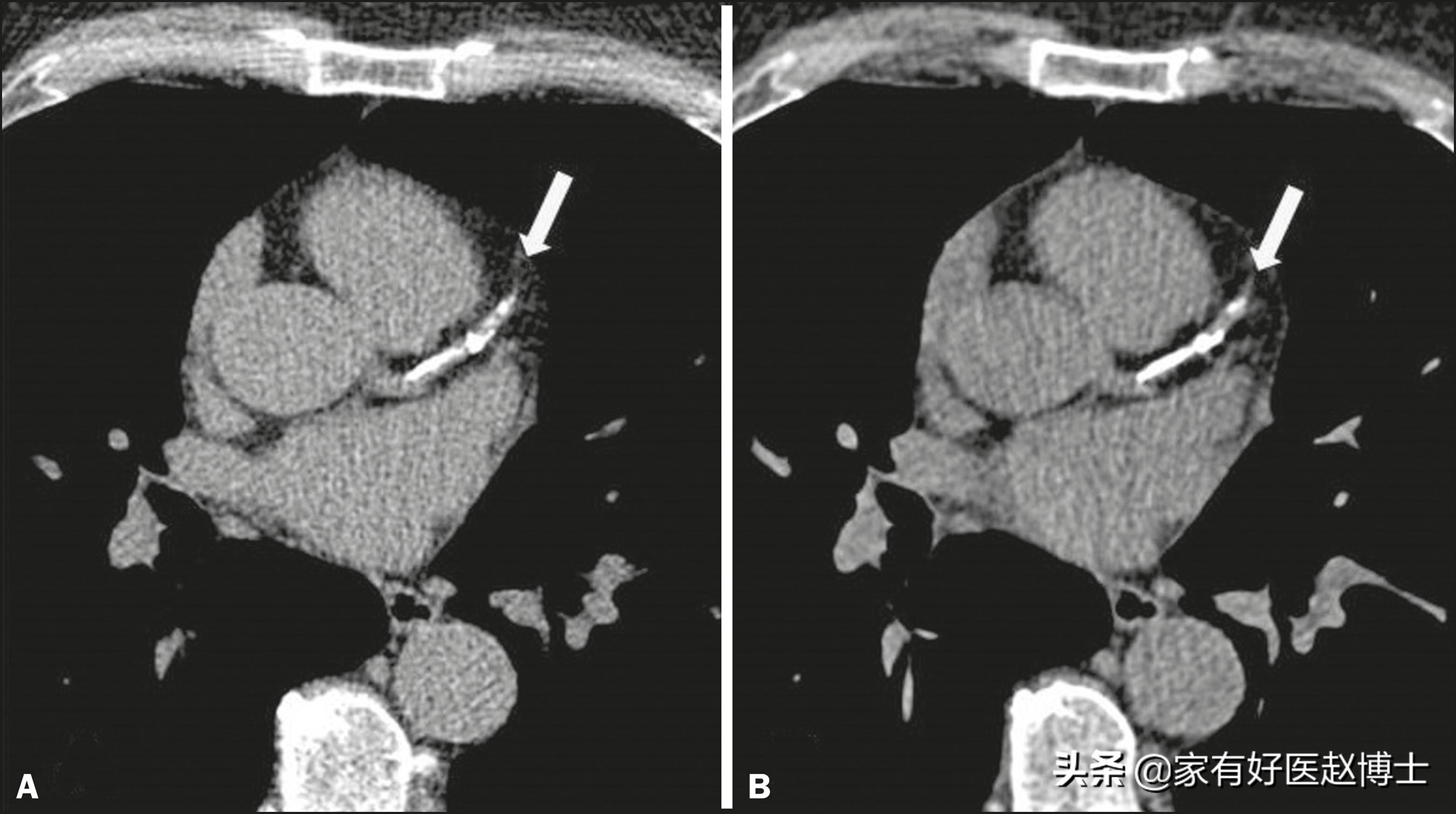 体检报告中常出现钙化哪些需警惕,钙化有什么症状和危害
