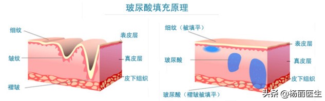 注射玻尿酸脸部浮肿怎么办,什么玻尿酸注射鼻子不会扩散