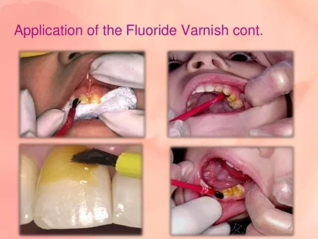 为什么牙齿会蛀牙儿童科普,儿童牙齿长白点是蛀牙吗