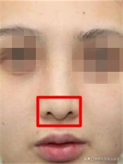 短塌鼻子可以做成直鼻吗,塌鼻子怎么能变成尖鼻子