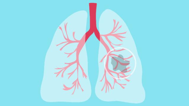 肺部结节警惕肺癌,肺部结节中危