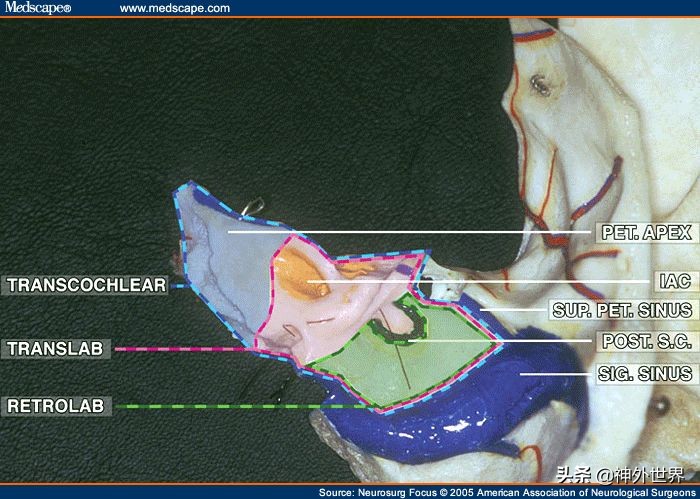 颞骨解剖,颞肌解剖讲解