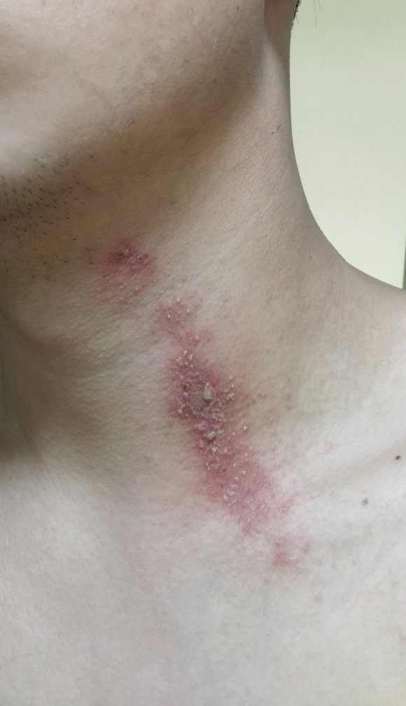 隐翅虫皮炎皮肤变硬脱皮,隐翅虫皮炎和湿疹的区别